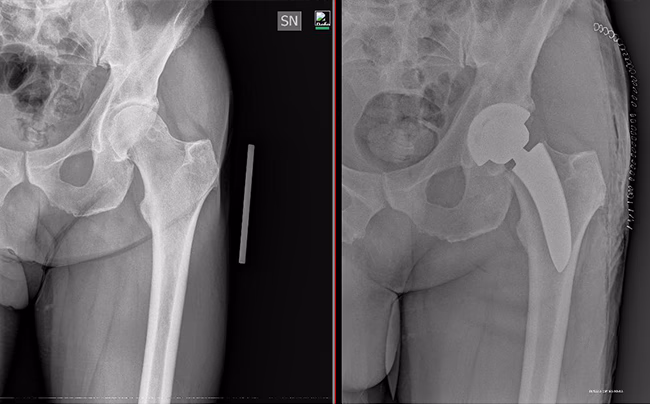 Radiografia che msotra il prima e il dopo di un'operazione per l'applicazione di una protesi all'anca