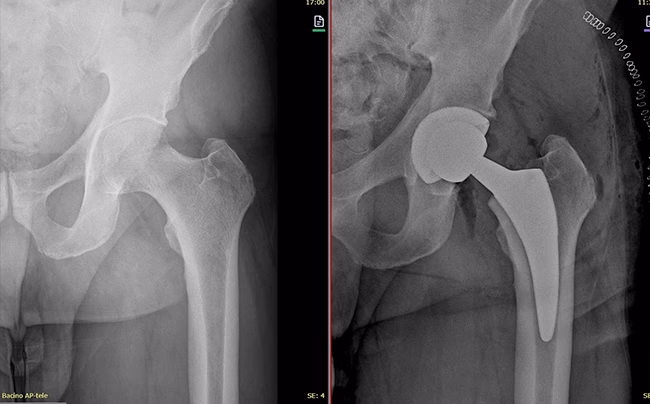 Radiografia che msotra il prima e il dopo di un'operazione per l'applicazione di una protesi all'anca