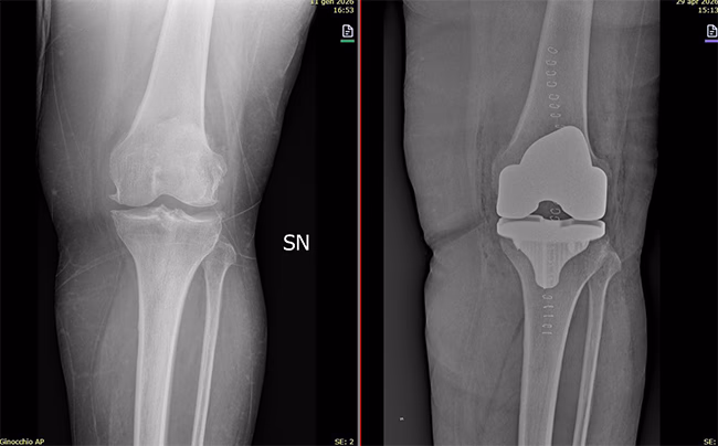 Radiografia che msotra il prima e il dopo di un'operazione per l'applicazione di una protesi al ginocchio
